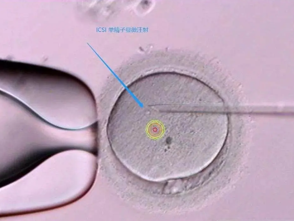 我在试管胚胎移植之后只移植一个胚胎为什么会有两个宝宝